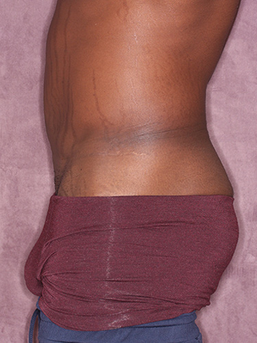 Case--36791 | Before Body Lift for Men 5