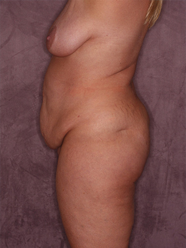 Case--37163 | Before Liposuction 5