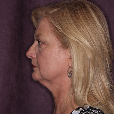 Case--36776 | Before Brow Lift 5