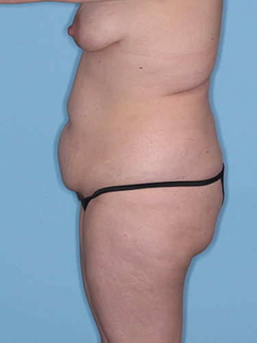 Case--37797 | Before Fat Transfer to Buttocks 5