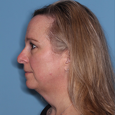 Case--36591 | Before Facelift and Neck Lift 5