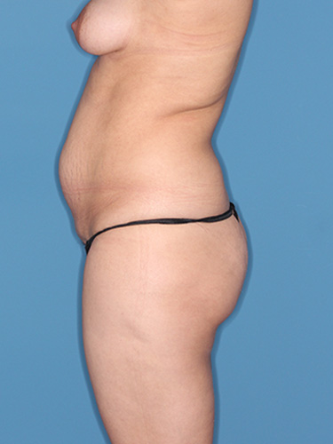 Case--39495 | Before Liposuction 5