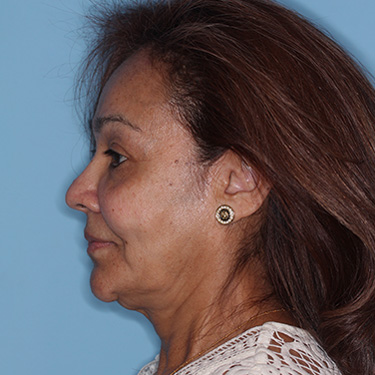 Case--38938 | Before Eyelid Surgery (Blepharoplasty) 5