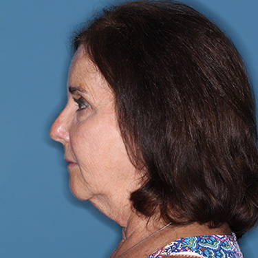 Case--38087 | Before Brow Lift 5