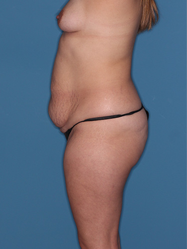 Case--41922 | Before Fat Transfer to Buttocks 5