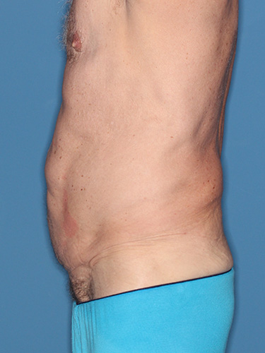 Case--40026 | Before True Form Tummy Tuck® for Men 5