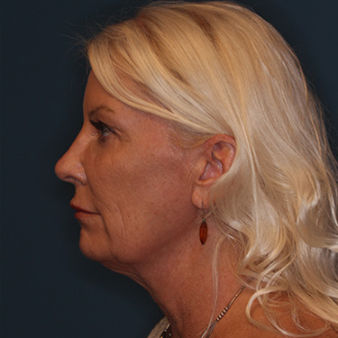 Case--40232 | Before Facelift and Neck Lift 5