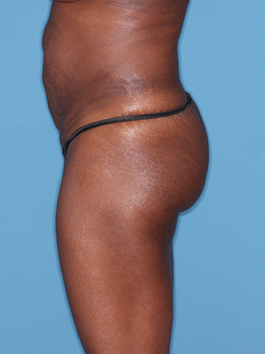 Case--39563 | Before True Form Tummy Tuck® 5