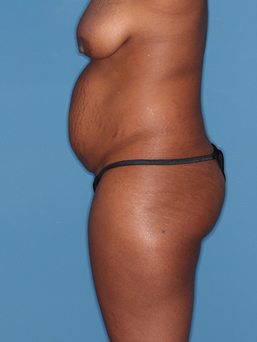 Case--40753 | Before Liposuction 5