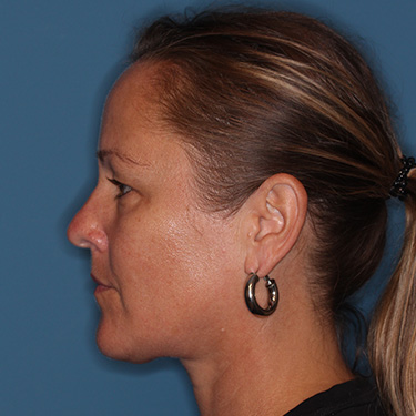 Case--40014 | Before Eyelid Surgery (Blepharoplasty) 5