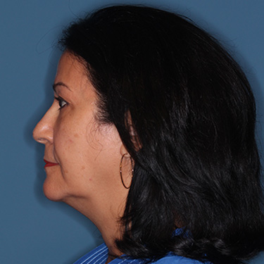 Case--40089 | Before Eyelid Surgery (Blepharoplasty) 5