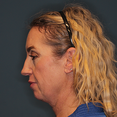 Case--43126 | Before Eyelid Surgery (Blepharoplasty) 5