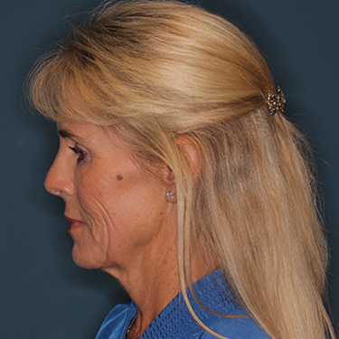 Case--837079 | Before Brow Lift 5