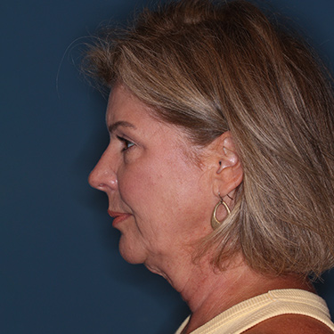 Case--38239 | Before Eyelid Surgery (Blepharoplasty) 5