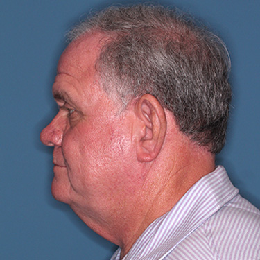 Case--40393 | Before Facelift and Neck Lift for Men 5