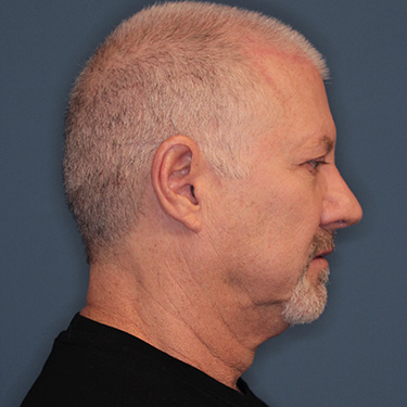 Case--40290 | Before Facelift and Neck Lift for Men 4