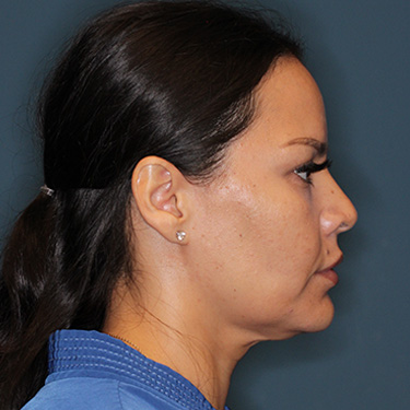 Case--42025 | Before Facelift and Neck Lift 4