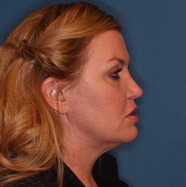 Case--41496 | Before Eyelid Surgery (Blepharoplasty) 4