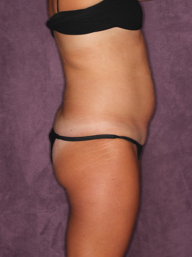 Case--39748 | Before Liposuction 4