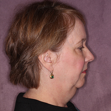 Case--36018 | Before Eyelid Surgery (Blepharoplasty) 3