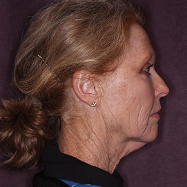 Case--36727 | Before Facelift and Neck Lift 4
