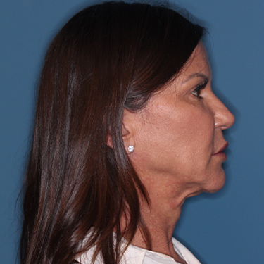 Case--37967 | Before Facelift and Neck Lift 4