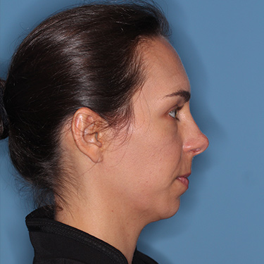 Case--36005 | Before Nose Surgery (Rhinoplasty) 3