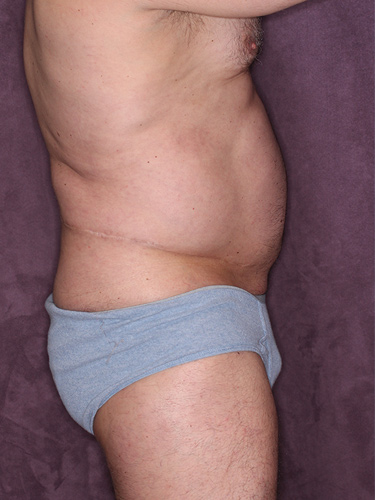 Case--36808 | Before True Form Tummy Tuck® for Men 4