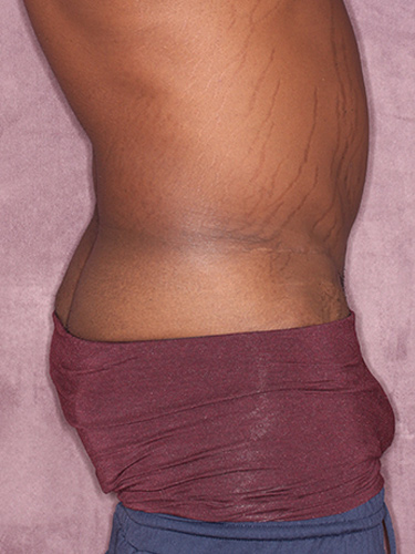 Case--36791 | Before Body Lift for Men 4
