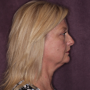 Case--36776 | Before Brow Lift 4