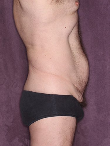 Case--36843 | Before Liposuction for Men 5