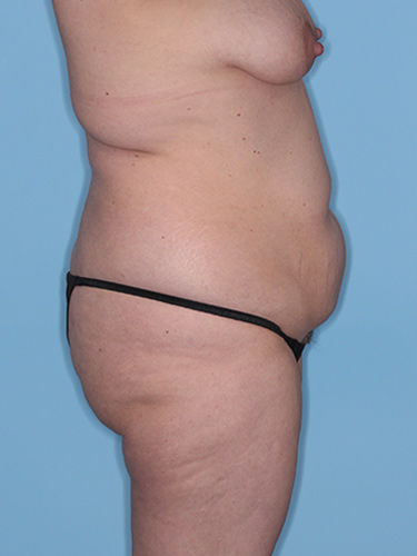 Case--37797 | Before Fat Transfer to Buttocks 4