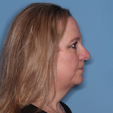 Case--36591 | Before Facelift and Neck Lift 4