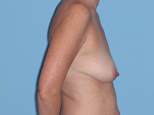 Case--38136 | Before Breast Lift 4
