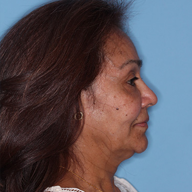 Case--38938 | Before Eyelid Surgery (Blepharoplasty) 4