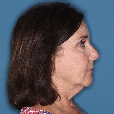 Case--38087 | Before Brow Lift 4