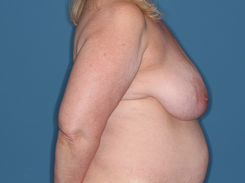 Case--40356 | Before Breast Lift with Breast Reduction 4