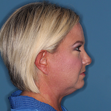 Case--39150 | Before Eyelid Surgery (Blepharoplasty) 4