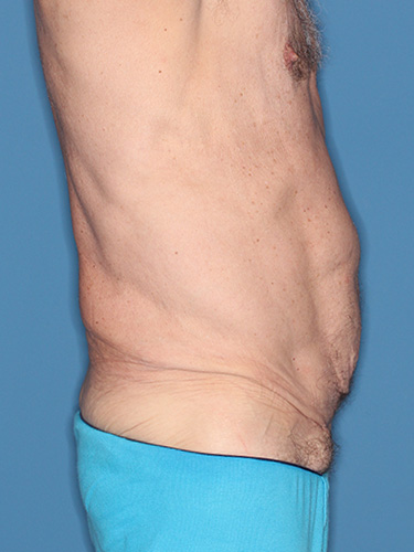 Case--40026 | Before True Form Tummy Tuck® for Men 4