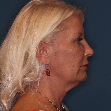 Case--40232 | Before Facelift and Neck Lift 4