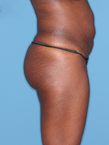 Case--39563 | Before True Form Tummy Tuck® 4