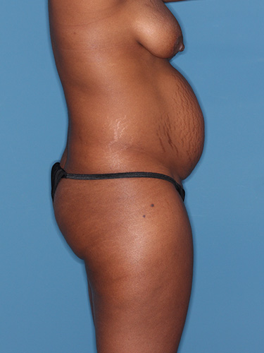 Case--40753 | Before Liposuction 4