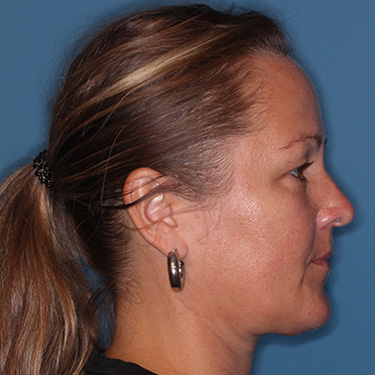 Case--40014 | Before Eyelid Surgery (Blepharoplasty) 4