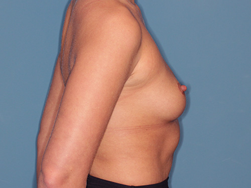 Case--40437 | Before Breast Augmentation 4