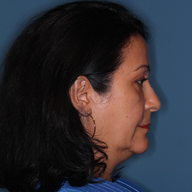 Case--40089 | Before Eyelid Surgery (Blepharoplasty) 4