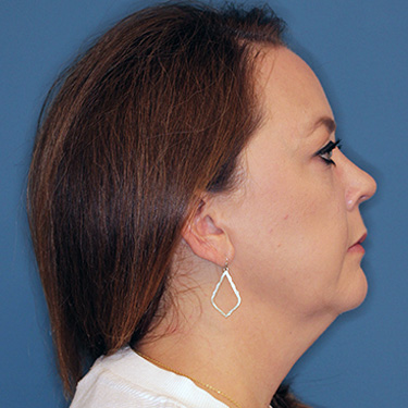 Case--40200 | Before Facelift and Neck Lift 4
