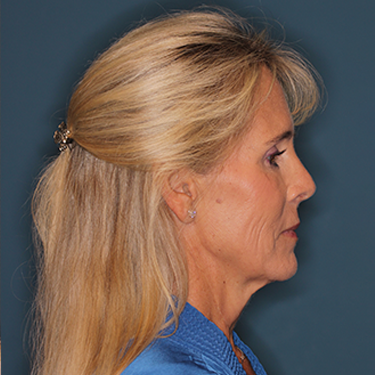 Case--837079 | Before Brow Lift 3