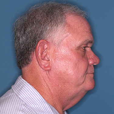 Case--40393 | Before Facelift and Neck Lift for Men 4