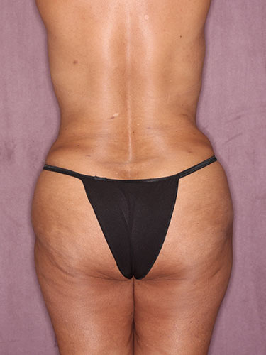 Case--32318 | After Fat Transfer to Buttocks 6