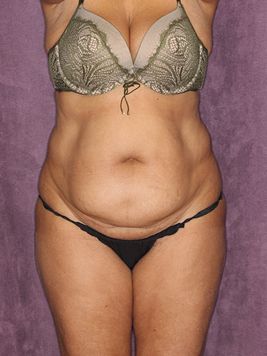 Case--32318 | Before Fat Transfer to Buttocks 1